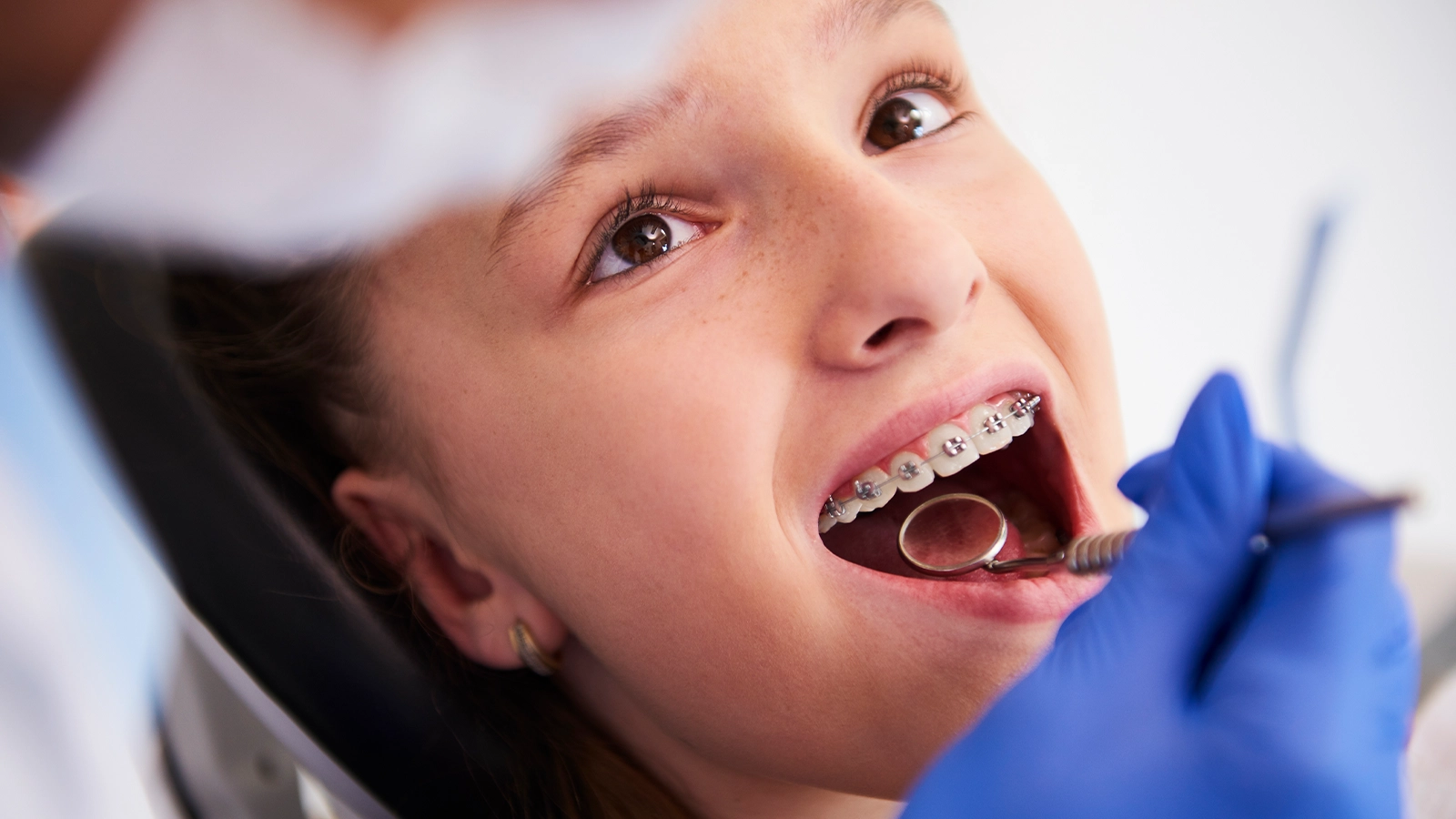 Dental Braces treatment