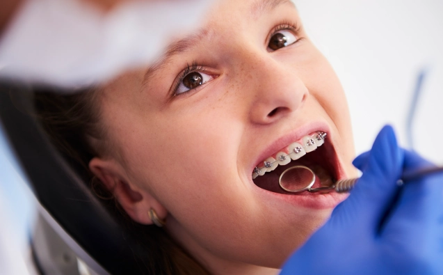 Dental Braces treatment