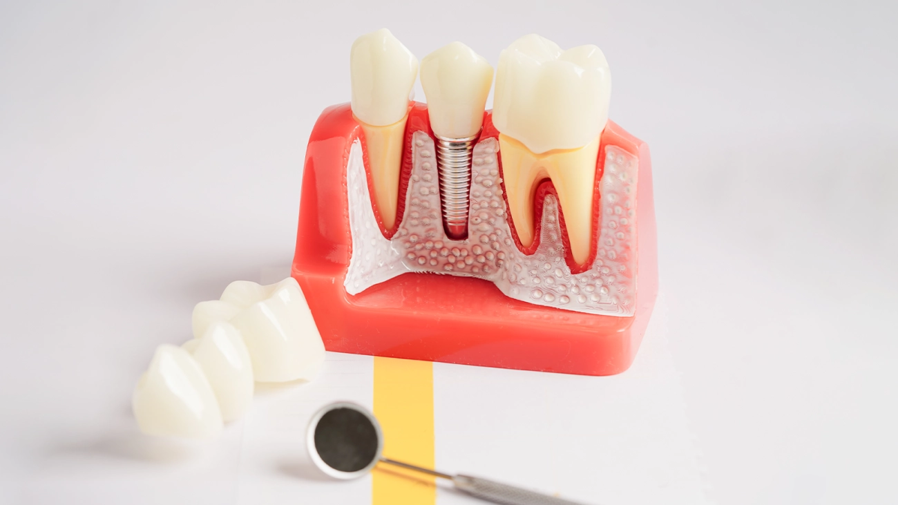 Dental implant