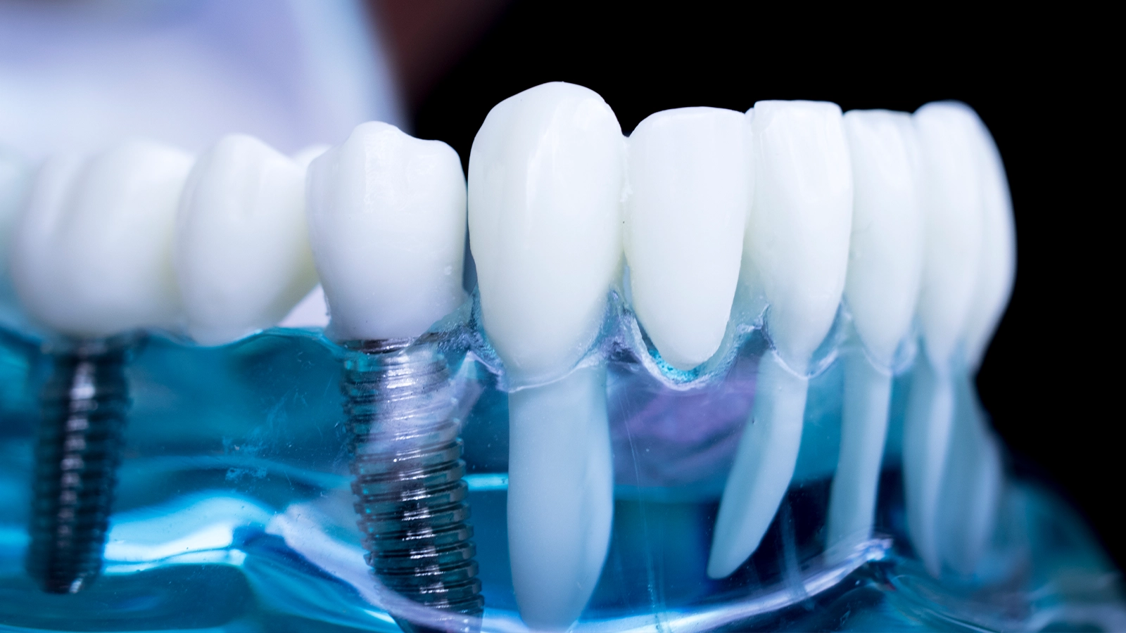 dental implant imag