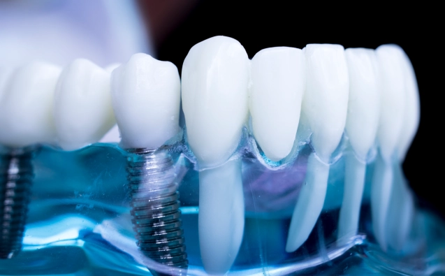 dental implant imag