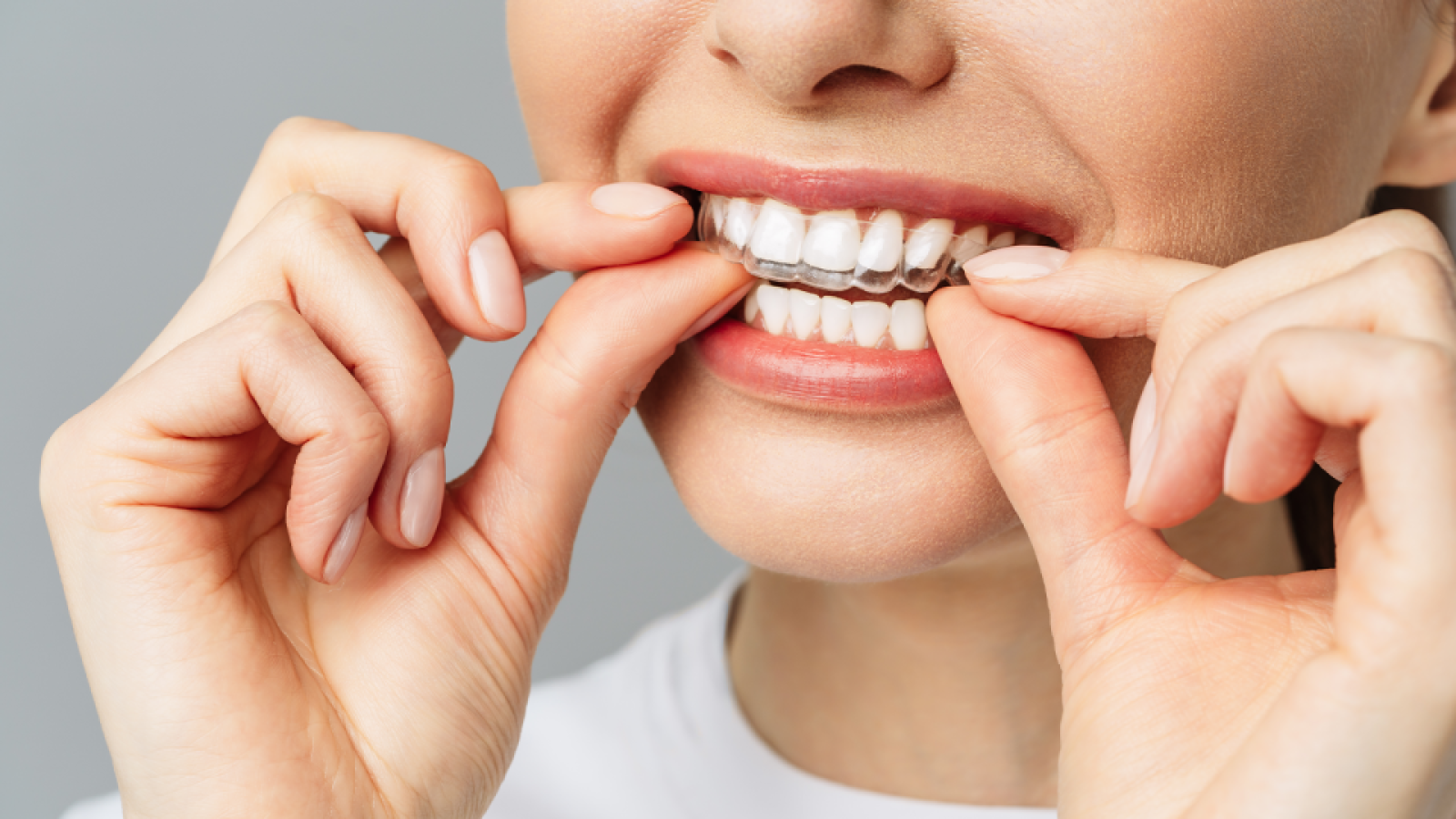 Clear aligner bite correction