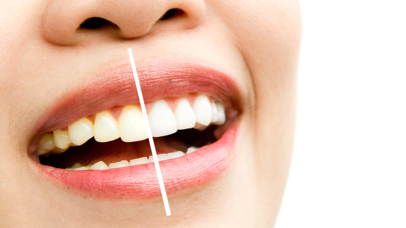 teeth whitening
