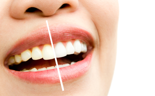 teeth whitening