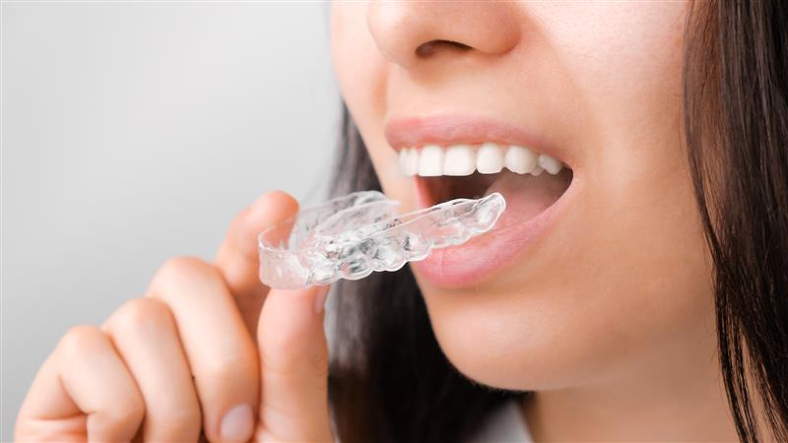 clear aligner image