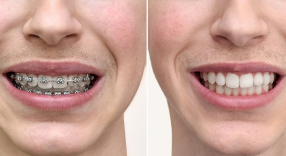 Braces treatment