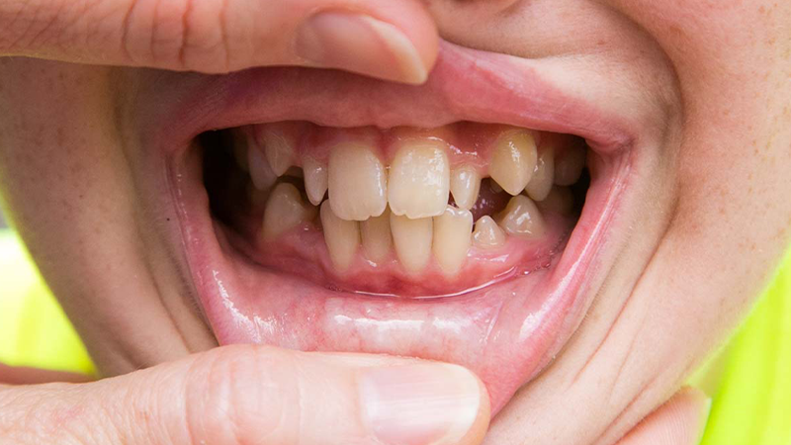 How to fix crooked teeth