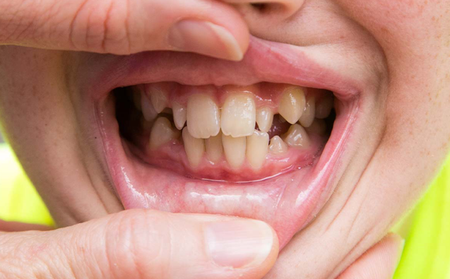 How to fix crooked teeth