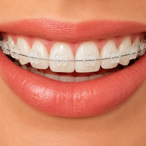 Ceramic Braces