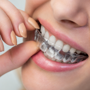 Clear Aligners