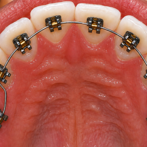Lingual Braces