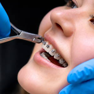 Metal Braces