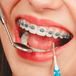 Self Ligating Braces