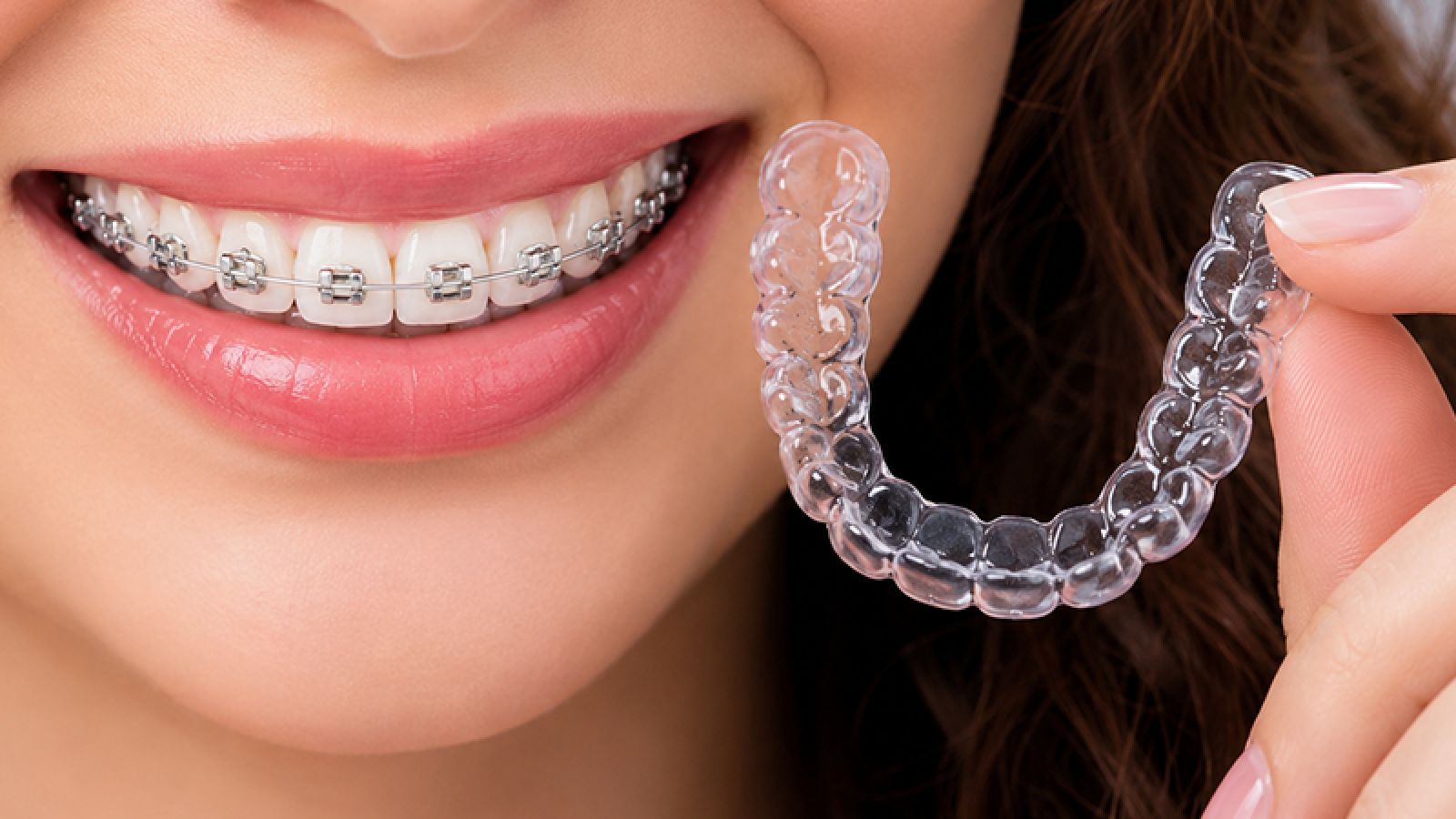 Types of Braces