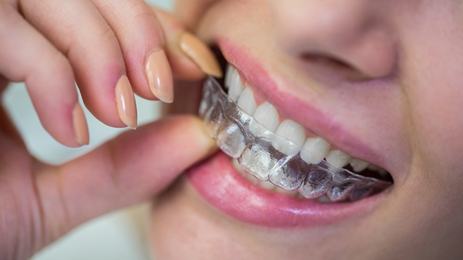 clear aligner attachments