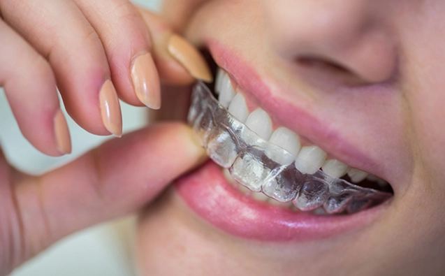 clear aligner attachments