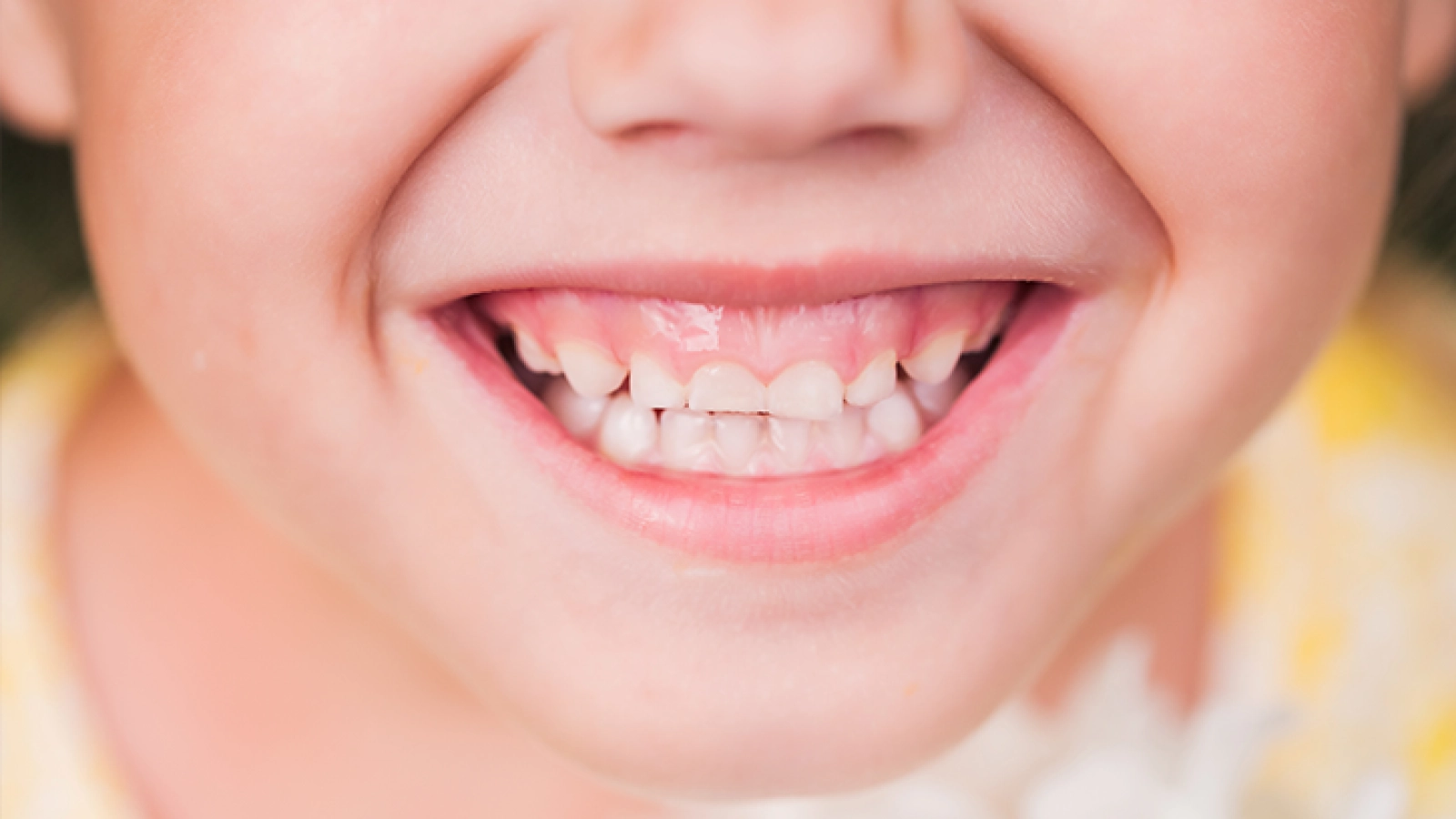 Gummy Smile Treatment