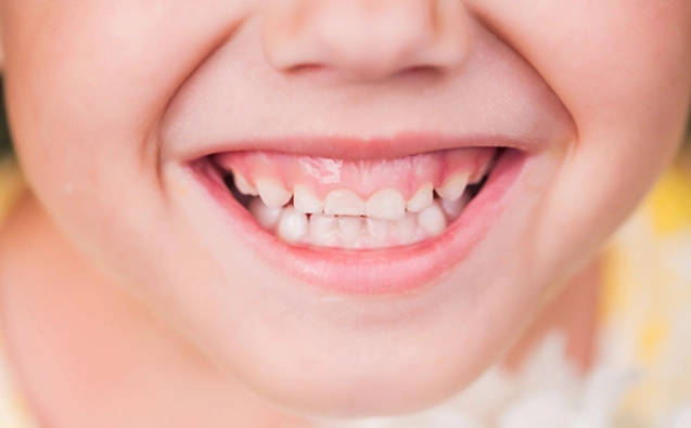 Gummy Smile Treatment